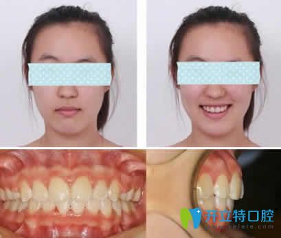 我在无锡通善口腔做隐形龅牙矫正一年后效果 我在无锡通善口腔做隐形龅牙矫正一年后效果