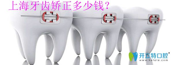 <!--<i data=20240703-sp></i>-->牙齿矫正多少钱 <!--<i data=20240703-sp></i>-->牙齿矫正多少钱
