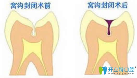 牙齿窝沟封闭前后对比图