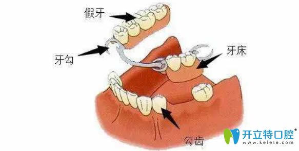 全口种植牙的价格和假牙为什么相差这么大