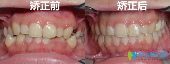 在厦门拜博口腔没拔牙正畸前后对比照 在厦门拜博口腔没拔牙正畸前后对比照