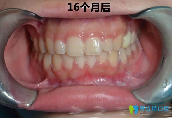 没拔牙矫正16个月后的正畸效果 没拔牙矫正16个月后的正畸效果
