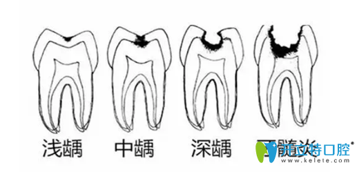 龋齿发展过程图