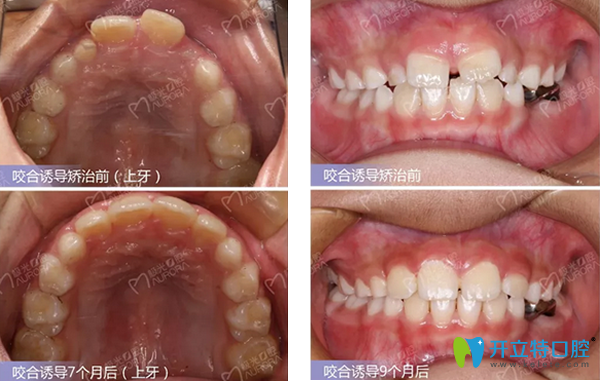 成都极光口腔正畸效果案例 成都极光口腔正畸效果案例