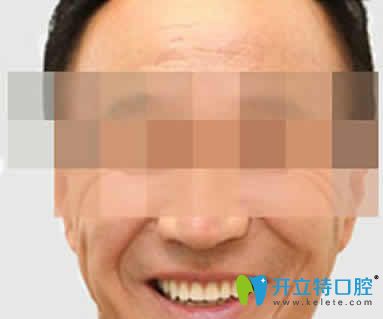 无锡通善口腔王杏松即刻种植牙案例效果图 无锡通善口腔王杏松即刻种植牙案例效果图