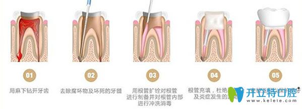 蛀牙根管治疗流程
