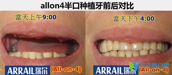 杭州瑞尔口腔allon4种植牙真实案例
