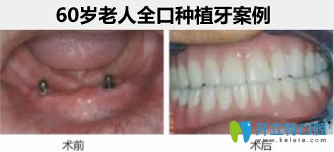 杭州瑞尔齿科<!--<i data=20240703-sp></i>-->鑫医生60岁老人全口种植牙案例