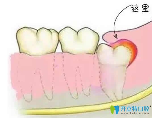 埋伏牙不拔除有什么危害