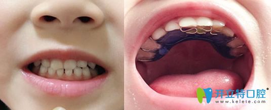 去哈尔滨大象口腔做牙齿矫正1个月变化图