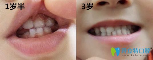 3岁孩子在哈尔滨大象口腔做牙齿地包天矫正前图片 3岁孩子在哈尔滨大象口腔做牙齿地包天矫正前图片