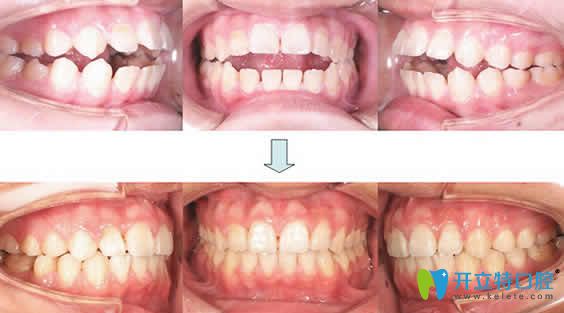 宁波尚善口腔李俏牙齿矫正前后效果对比图