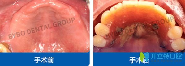 上海拜博口腔全口种植牙效果案例