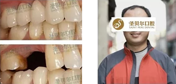 种植牙疼不疼要多久 大连圣贝尔口腔做过种植牙的人谈体会