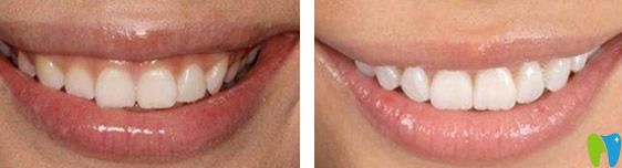 牙龈萎缩可通过植骨来修复