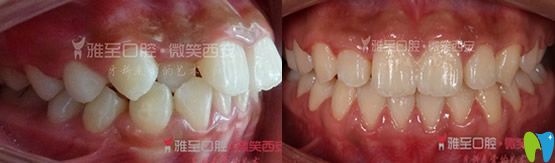 西安哪家牙齿矫正好？看雅至口腔牙齿隐形矫正案例对比图