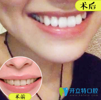 <!--<i data=20240703-sp></i>-->口腔牙齿瓷贴面案例 <!--<i data=20240703-sp></i>-->口腔牙齿瓷贴面案例