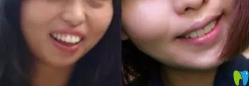 重庆牙科哪家好,看美维口腔龅牙矫正案例效果图 重庆牙科哪家好,看美维口腔龅牙矫正案例效果图