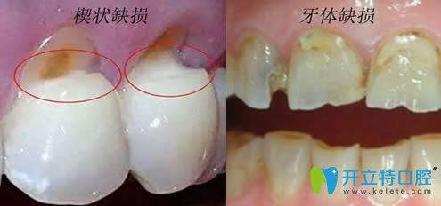 楔状缺损属于牙体缺损吗？听说楔状缺损不要盲目补牙