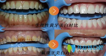 即墨西诺德口腔牙齿冷光美白效果对比图 即墨西诺德口腔牙齿冷光美白效果对比图