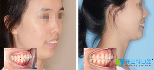 成都新桥口腔龅牙矫正效果案例 成都新桥口腔龅牙矫正效果案例