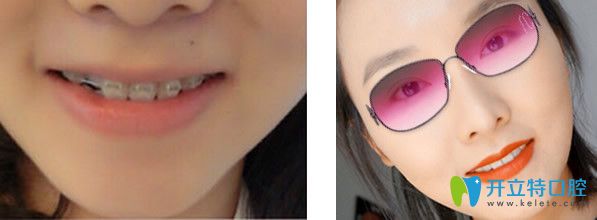 成都极光口腔自锁陶瓷托槽正畸效果好不好 成都极光口腔自锁陶瓷托槽正畸效果好不好