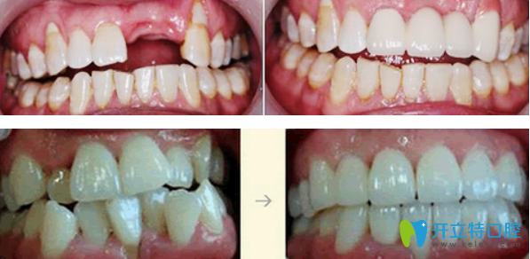 佳美口腔种植牙和牙齿矫正效果案例