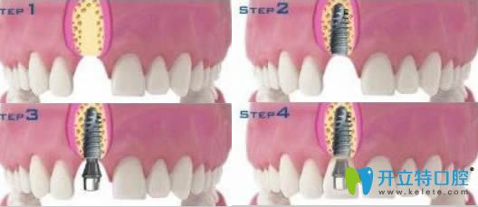 开立特口腔网牙齿种植图解