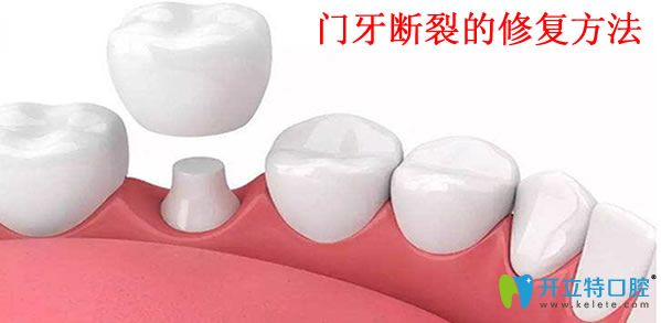 美丽雅口腔门牙断裂的修复方法 美丽雅口腔门牙断裂的修复方法