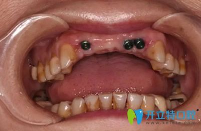 前牙缺失部位植入3颗种植体