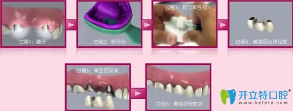 牙齿美容冠治疗步骤图