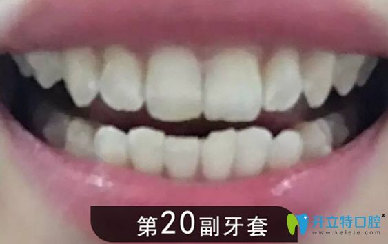 第20副牙套的矫正效果图
