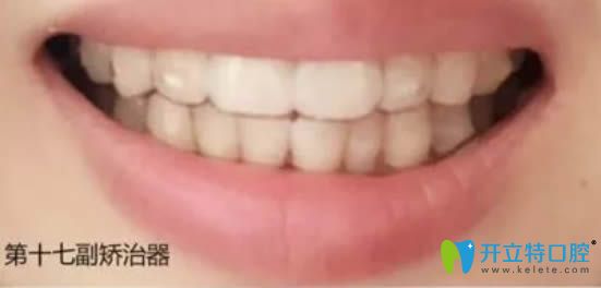 在上海华美佩戴第17副隐适美牙套的效果