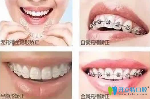 成年人牙齿矫正的方法
