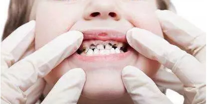 儿童龋齿的原因有哪些 看完后才知道小孩为什么容易烂牙