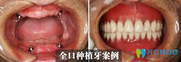全口牙缺失即刻种植牙案例 全口牙缺失即刻种植牙案例
