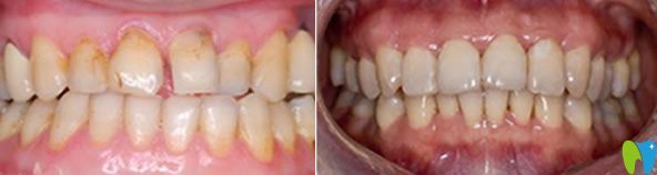 大连沙医生口腔牙龈萎缩修复后效果对比图