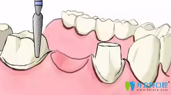 烤瓷牙容易引发牙龈萎缩。