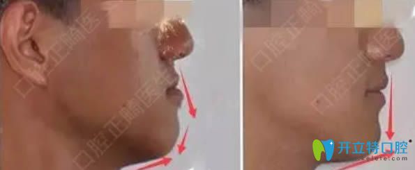 成都圣贝贾永庆医生深覆合矫正及脸型变化图 成都圣贝贾永庆医生深覆合矫正及脸型变化图