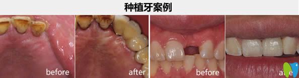 南昌维乐口腔汪文文种植牙实例 南昌维乐口腔汪文文种植牙实例