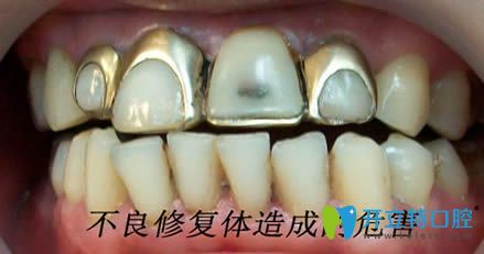 开立特口腔不良修复体造成的危害 开立特口腔不良修复体造成的危害