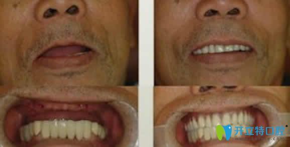 福州晶特尔齿科种植牙案例效果