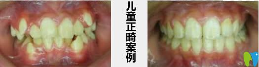 成都君臣儿童正畸案例及前后对比照 成都君臣儿童正畸案例及前后对比照