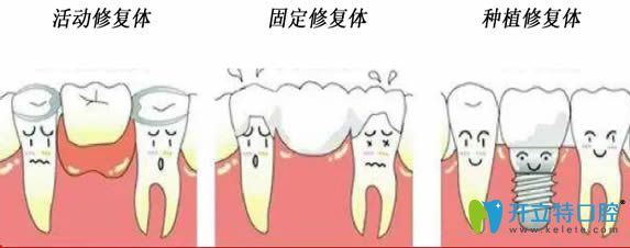 开立特口腔网牙齿修复体种类图