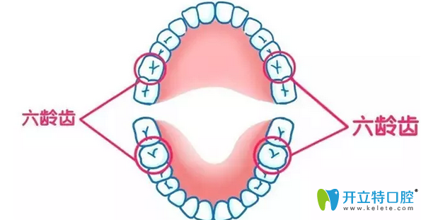 六龄齿对恒牙萌出以及排列整齐有很很大作用