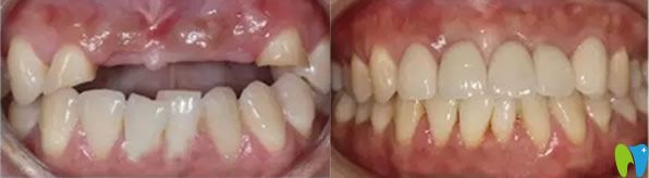 门牙缺失即刻种植牙效果对比图