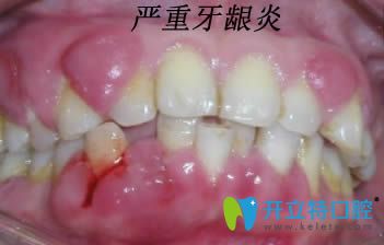 牙龈炎症状和图片以及边缘性牙龈炎的治疗方法都在这里