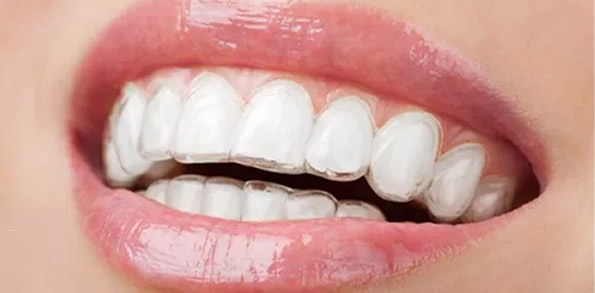 隐形矫正牙齿和传统牙套哪个好 福州东南口腔教您怎样选择