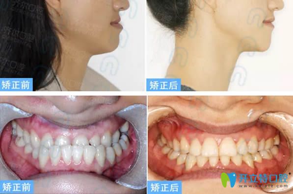 杭州齐尔口腔地包天牙齿矫正案例
