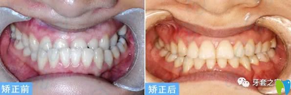 杭州齐尔口腔李诗佩地包天牙齿矫正案例及前后对比照